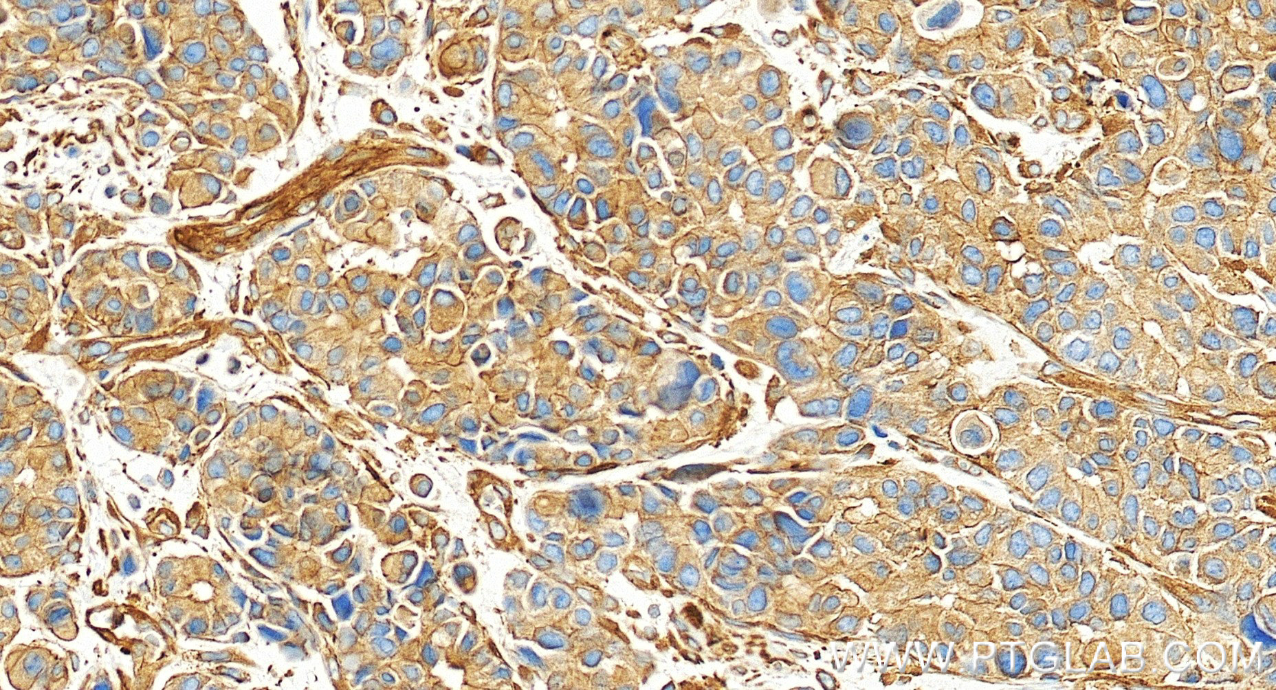 IHC staining of human stomach cancer using 86364-3-RR