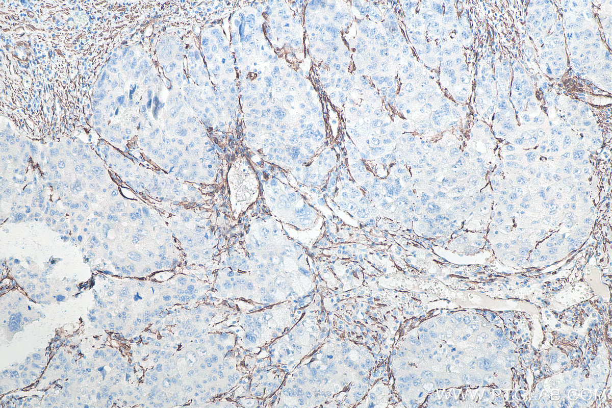 IHC staining of human liver cancer using 80008-1-RR IHC staining of human liver cancer using 80008-1-RR