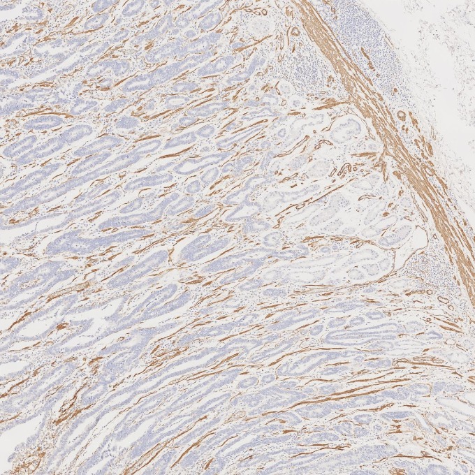 IHC staining of human stomach cancer using 80008-1-RR