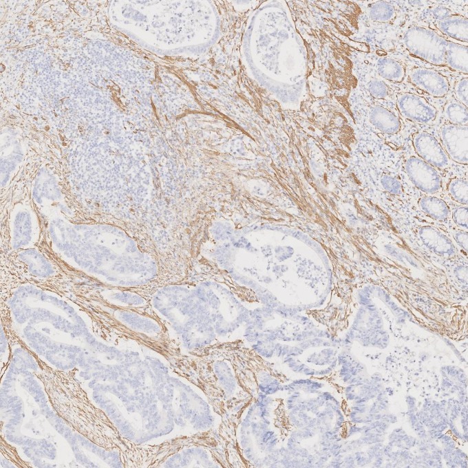 IHC staining of human colorectal cancer using 80008-1-RR