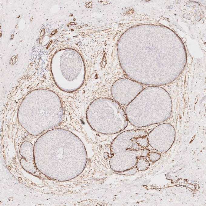 IHC staining of human breast cancer using 80008-1-RR