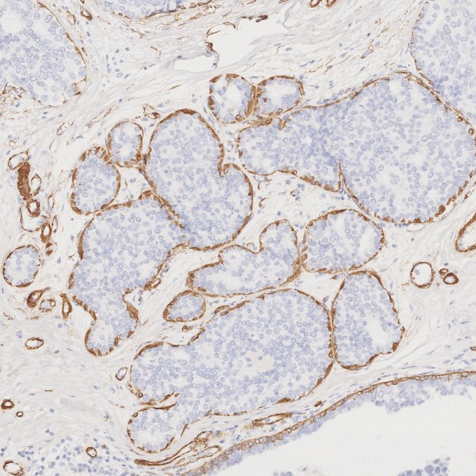IHC staining of human breast cancer using 80008-1-RR
