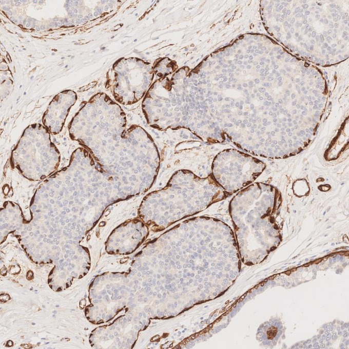 IHC staining of human breast cancer using 80008-1-RR