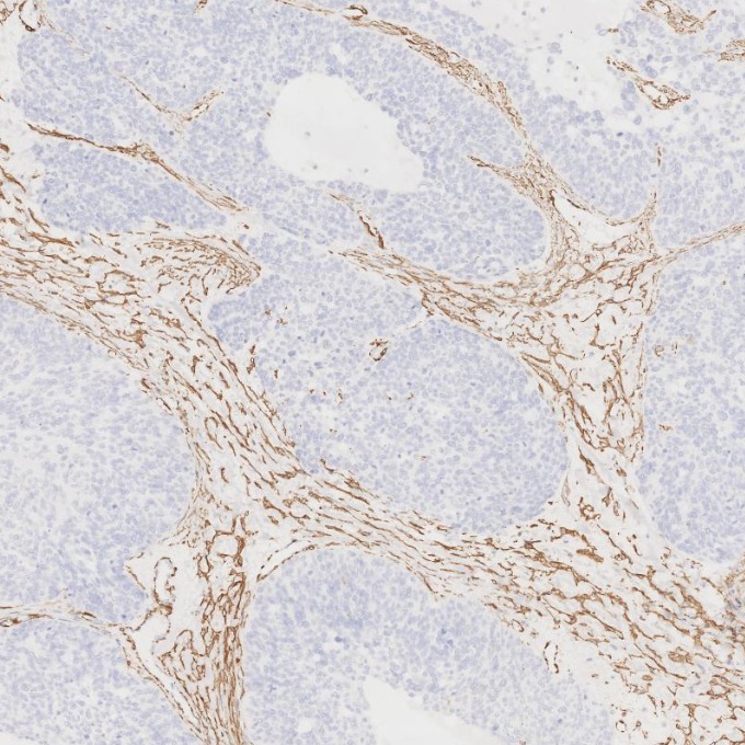 IHC staining of human ovary cancer using 80008-1-RR