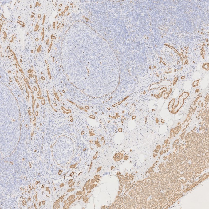 IHC staining of human appendicitis using 80008-1-RR