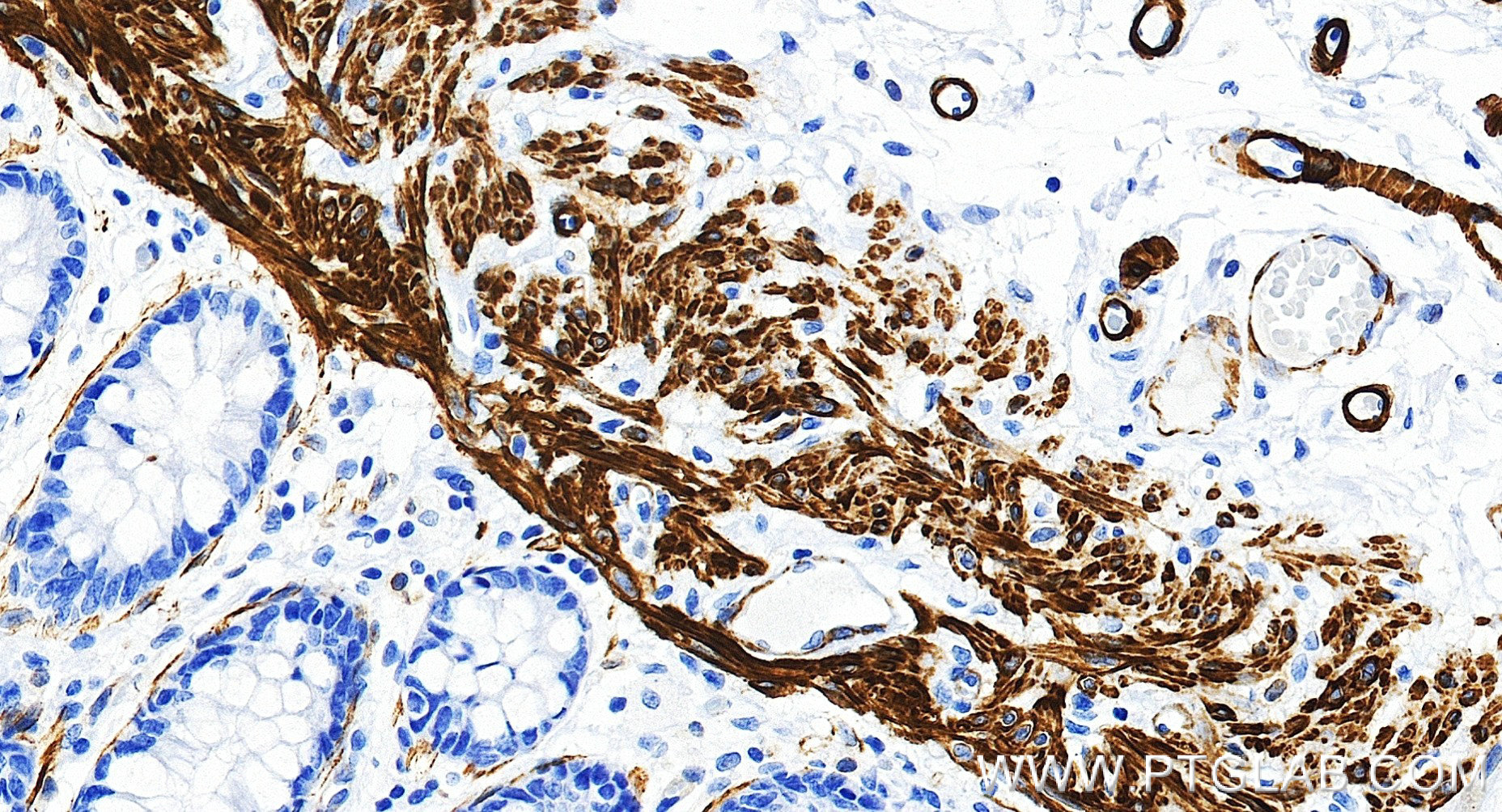 IHC staining of human colon using 80008-2-RR (same clone as 80008-2-PBS) IHC staining of human colon using 80008-2-RR (same clone as 80008-2-PBS)