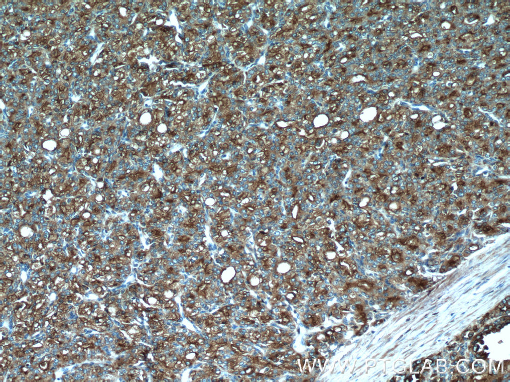 IHC staining of human prostate cancer using 24410-1-AP