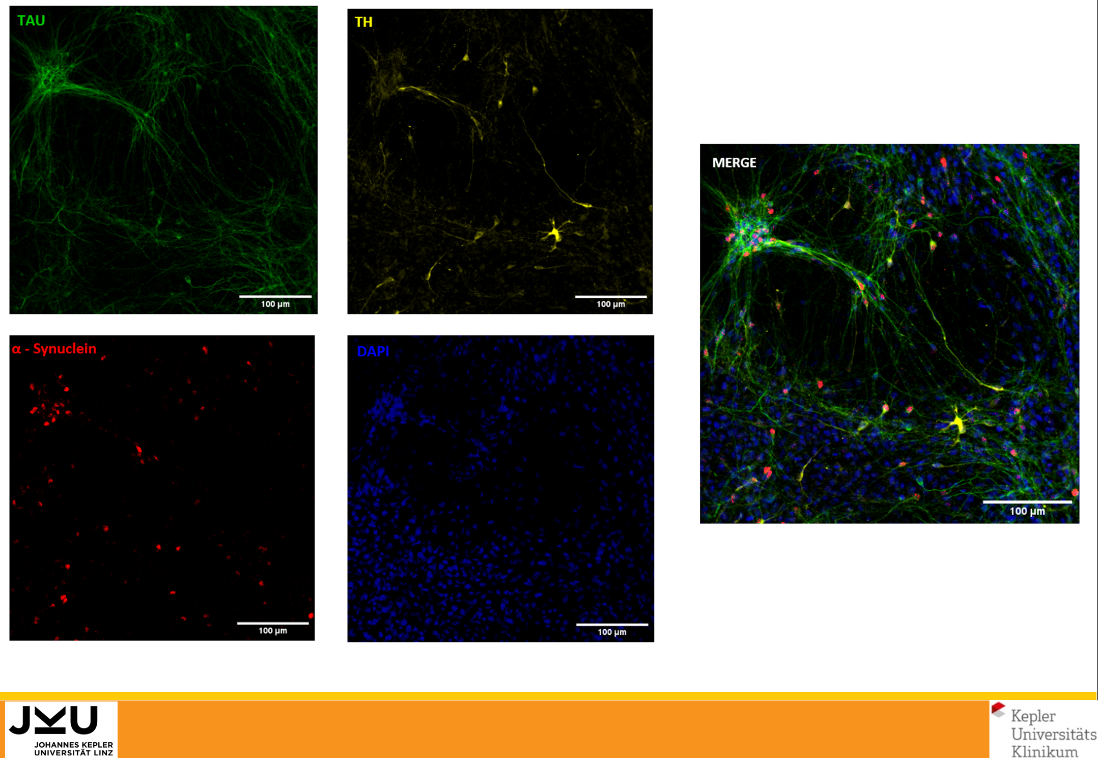 Human induced pluripotent cells(iPSCs) were differentiated to dopaminergic neurons using HumanKine growth factors (GDNF-HZ-1311 and FGF8B- HZ-1103). The differentiation was confirmed by detection of expression of TAU(green), Alpha-Synuclein(red) and Thyrosine hydoxylase(TH)(yellow) in immunofluorescence.(Credits- Credits- Alessandro Bellapianta
Johannes Kepler Universitat)