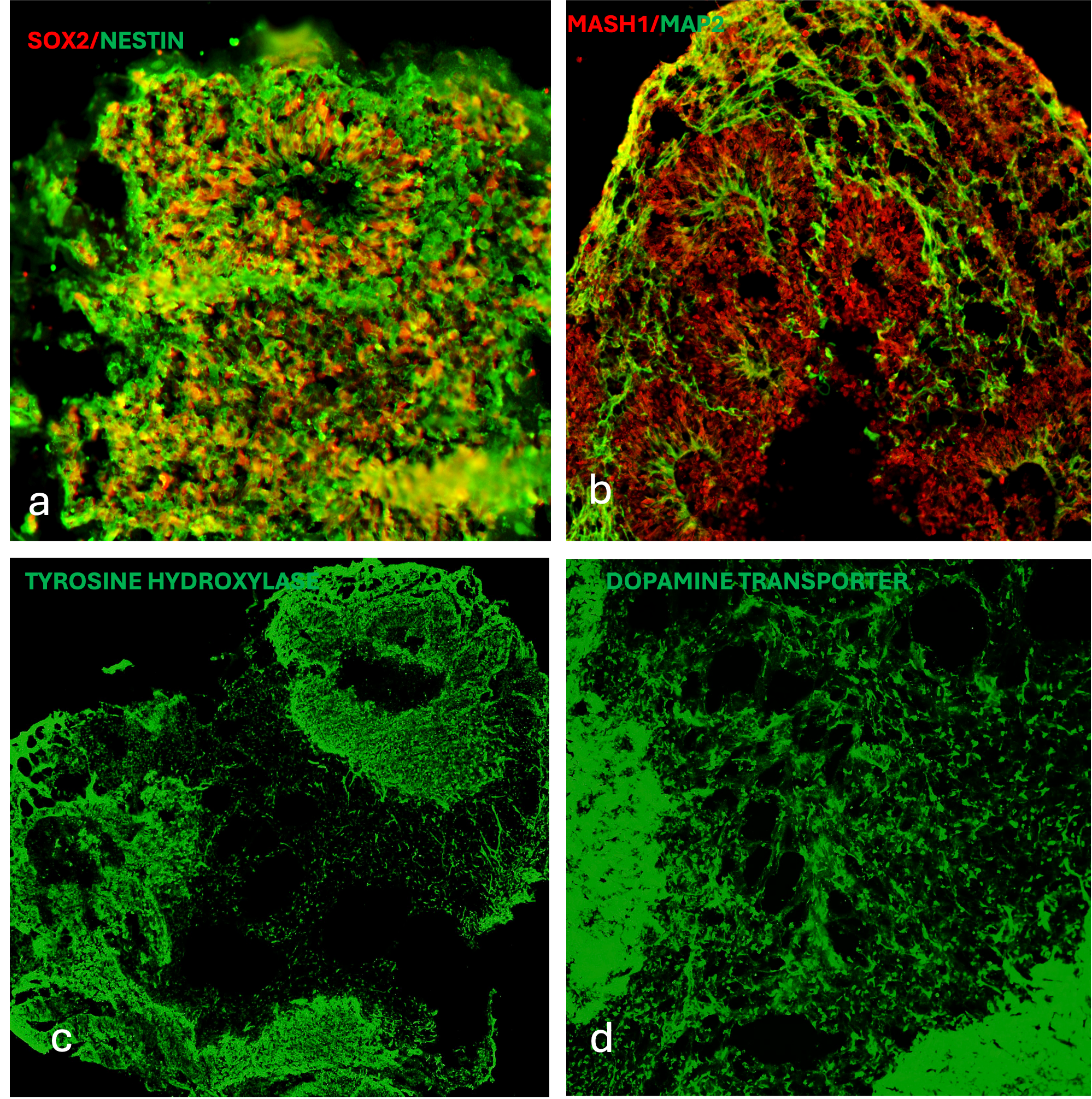 iPSC-derived Human Midbrain Organoids Cultured using Recombinant Human Noggin, Sonic Hedgehog (SHH), FGF-8B, GDNF and BDNF).
iPSCs differentiated to Midbrain organoids using HumanKine® recombinant human Noggin (HZ-1118), HumanKine® recombinant human SHH (HZ-1306), HumanKine® recombinant human FGF-8b (HZ-1103), HumanKine® recombinant human GDNF ( HZ-1311), HumanKine® recombinant human BDNF ( HZ-1335) were fixed and permeabilized for detection of endogenous SOX2 and Nestin (a) using SOX2 Monoclonal antibody (Product # 66411-1-Ig, 1:400 dilution, labelled with Multi-rAb™ CoraLite® Plus 594-Goat Anti-Mouse Recombinant Secondary Antibody (H+L) (RGAM004)), and Nestin Polyclonal antibody (Product # 19483-1-AP, 1:200 dilution, labelled with Multi-rAb® CoraLite® Plus 488-Goat Anti-Rabbit Recombinant Secondary Antibody (H+L) (RGAR002) and (b) detection of endogenous MASH1 and MAP2 ASCL1 (MASH1) Polyclonal antibody (Product # 31206-1-AP, 1:200 dilution,  labelled with Multi-rAb® CoraLite® Plus 488-Goat Anti-Rabbit Recombinant Secondary Antibody (H+L) (RGAR002)) and MAP2 Monoclonal antibody (Product # 67015-1-Ig, 1:2000 dilution, labelled with Multi-rAb™ CoraLite® Plus 594-Goat Anti-Mouse Recombinant Secondary Antibody (H+L) (RGAM004)). (c and d) and detection of endogenous TH and DAT using TH Polyclonal antibody (Product #25859-1-AP, 1:200 dilution, labelled with Multi-rAb® CoraLite® Plus 488-Goat Anti-Rabbit Recombinant Secondary Antibody (H+L) (RGAR002) ) and Dopamine Transporter/DAT Polyclonal antibody (Product # 22524-1-AP, 1:200 dilution, labelled with Multi-rAb® CoraLite® Plus 488-Goat Anti-Rabbit Recombinant Secondary Antibody (H+L) (RGAR002)).

 

