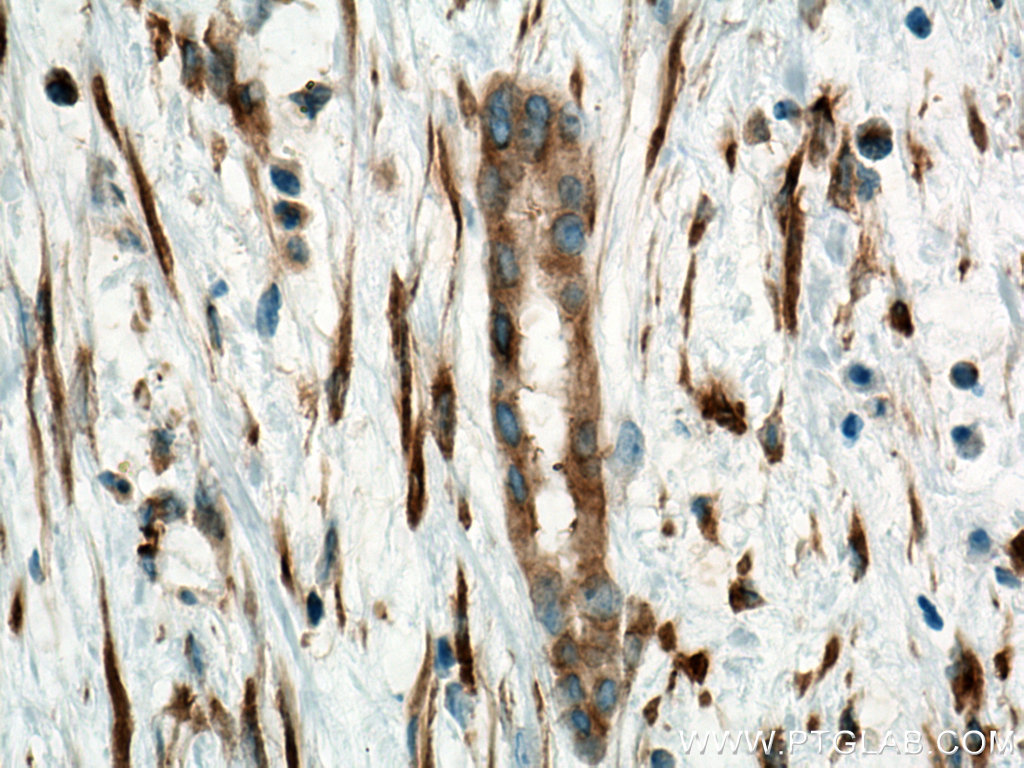 IHC staining of human liver cancer using Biotin-66031