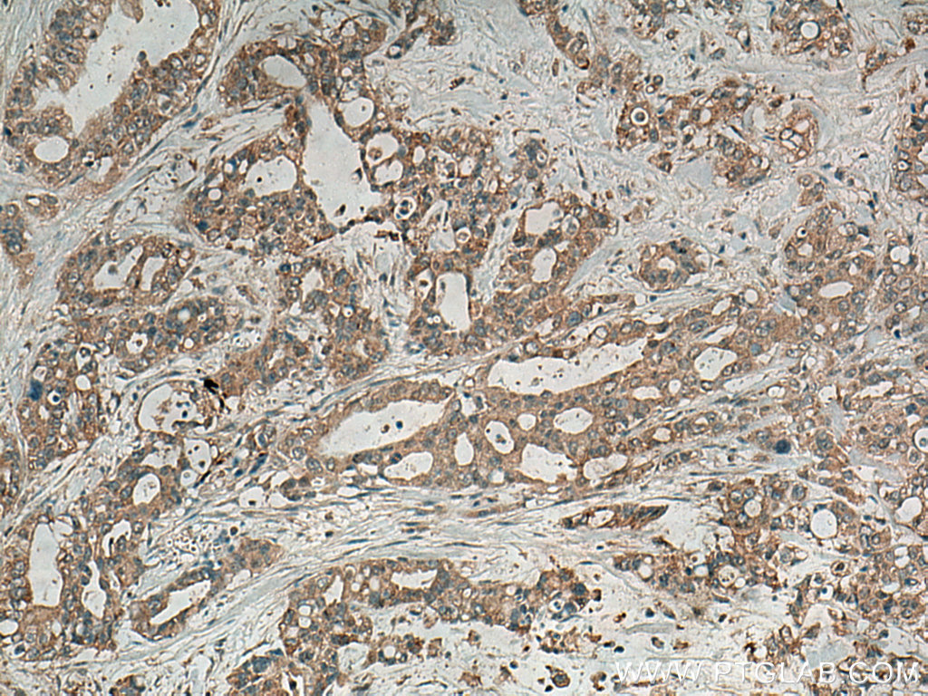 IHC staining of human pancreas cancer using 23881-1-AP