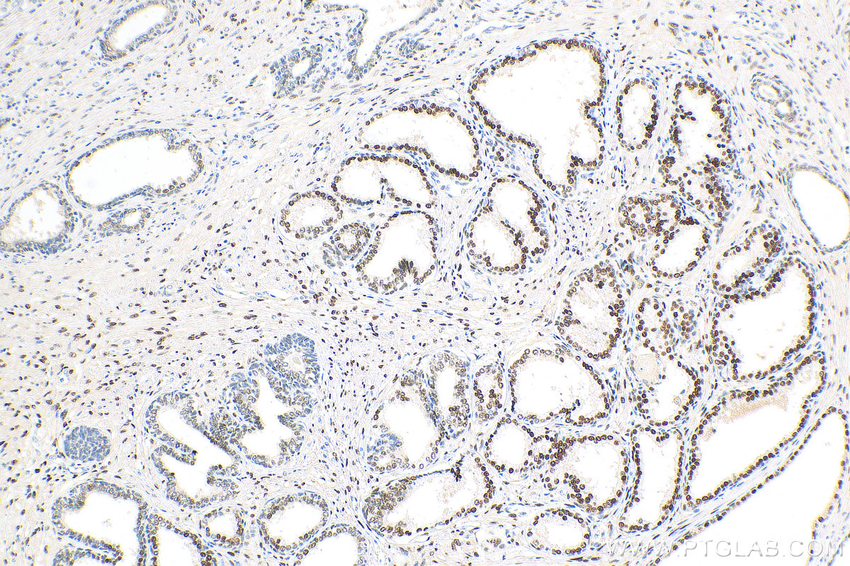 IHC staining of human prostate cancer using 81844-1-RR