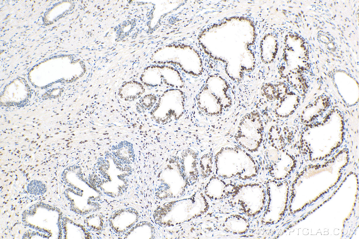 IHC staining of human prostate cancer using 81844-1-RR (same clone as 81844-1-PBS)