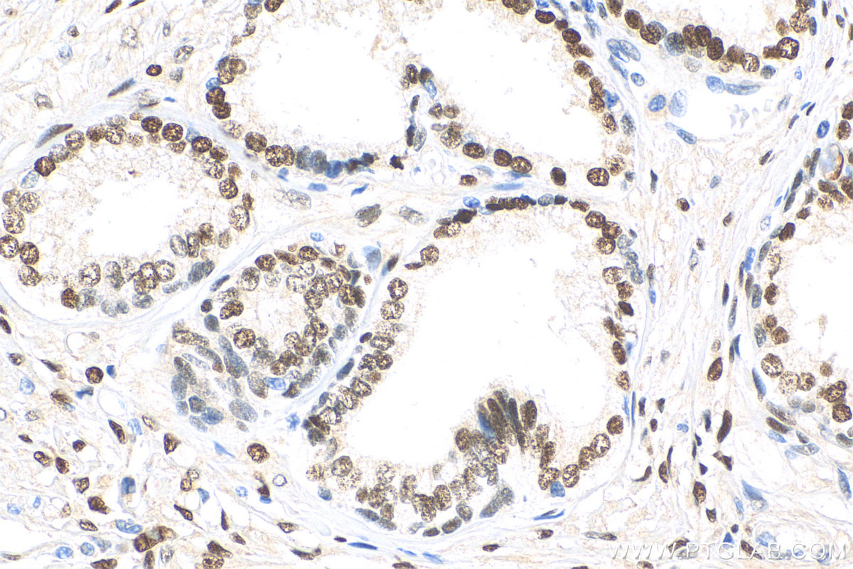 IHC staining of human prostate cancer using 81844-1-RR