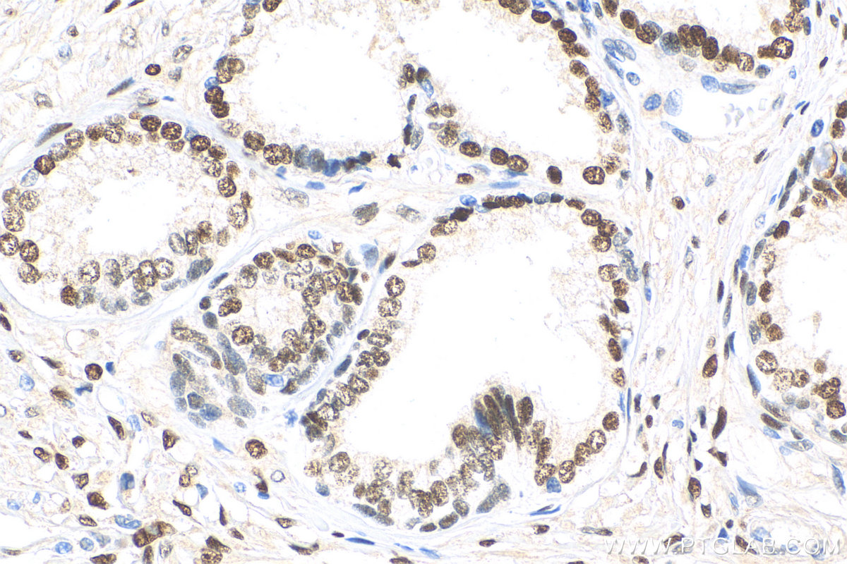 IHC staining of human prostate cancer using 81844-1-RR (same clone as 81844-1-PBS)