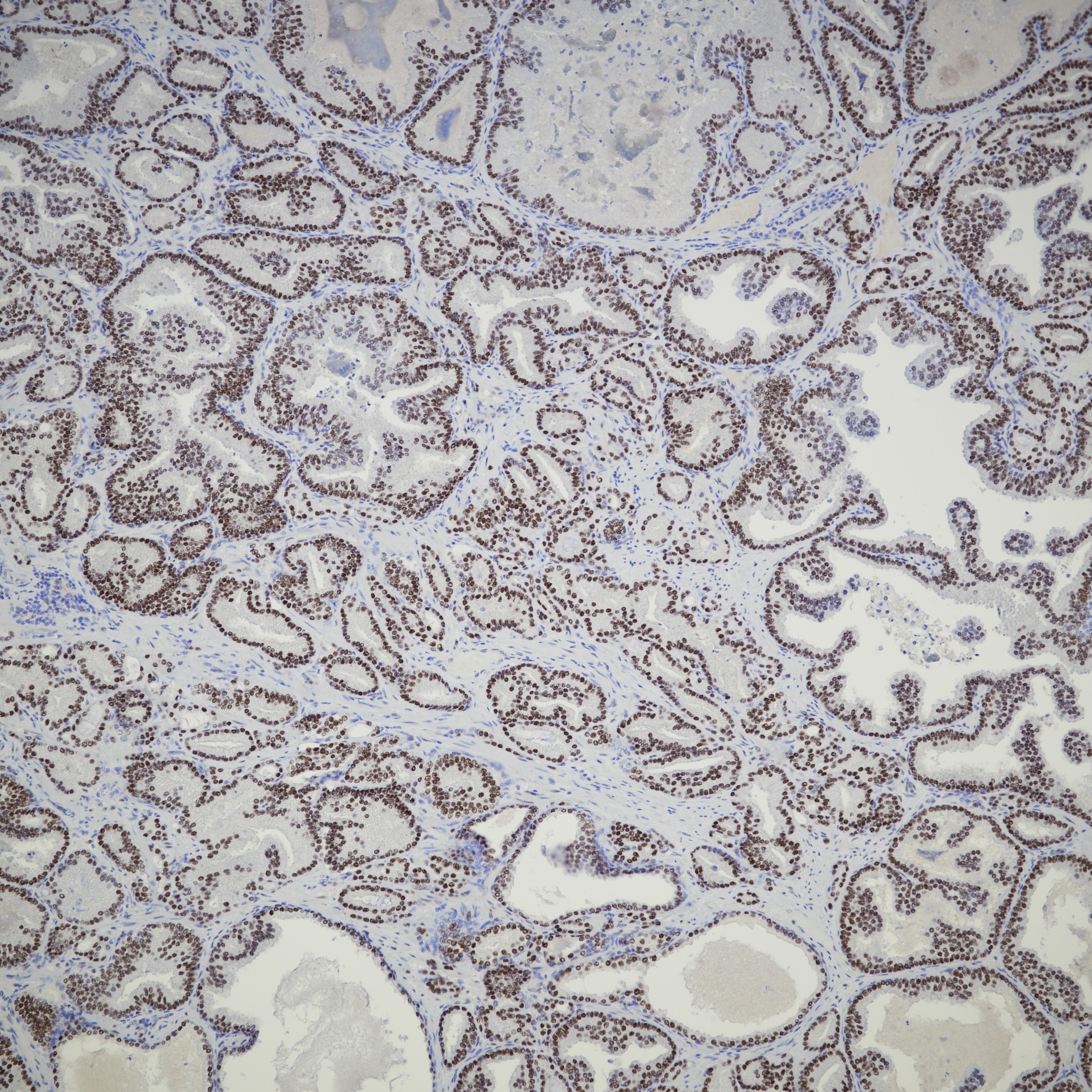 IHC staining of human prostate cancer using 81844-1-RR IHC staining of human prostate cancer using 81844-1-RR