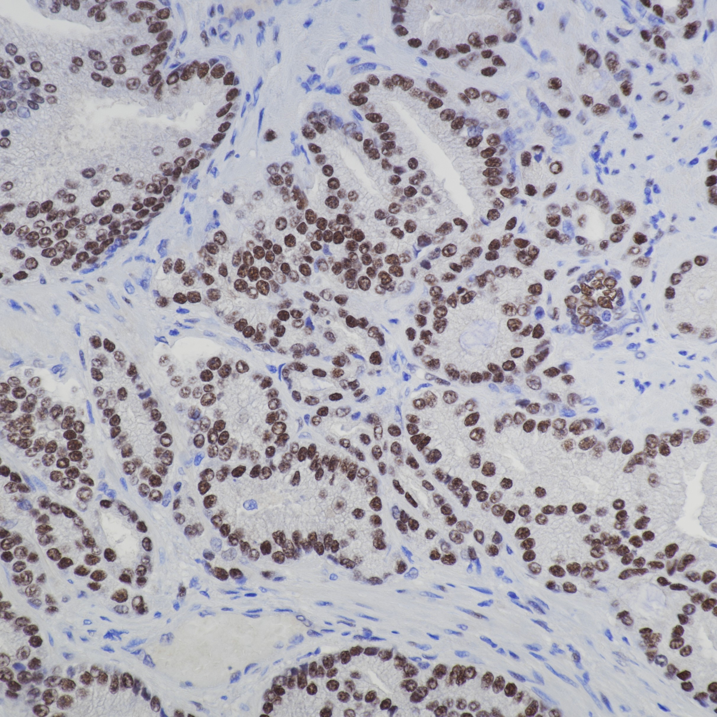 IHC staining of human prostate cancer using 81844-1-RR IHC staining of human prostate cancer using 81844-1-RR