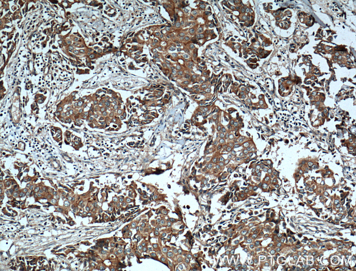 IHC staining of human breast cancer using 25978-1-AP