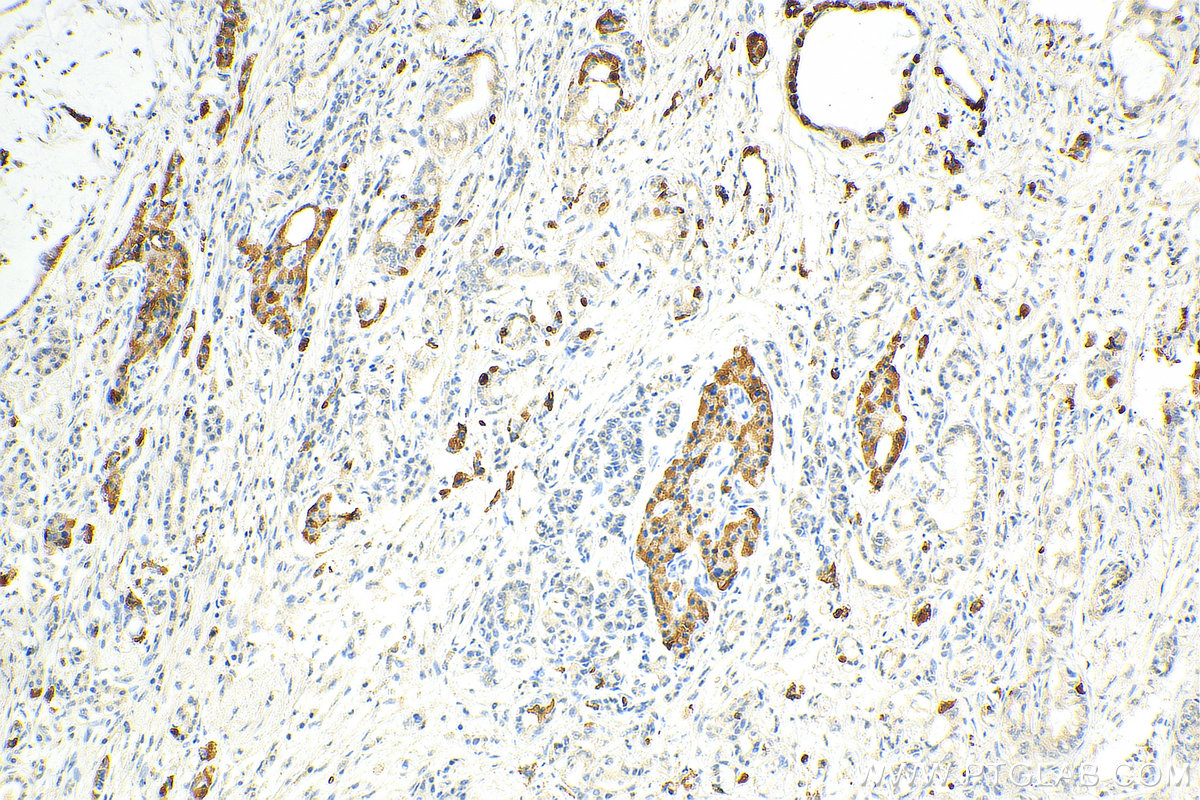 IHC staining of human pancreas cancer using 60135-2-Ig