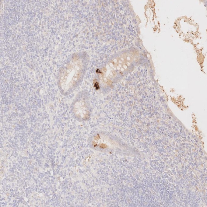 IHC staining of human appendicitis using 60135-2-Ig IHC staining of human appendicitis using 60135-2-Ig