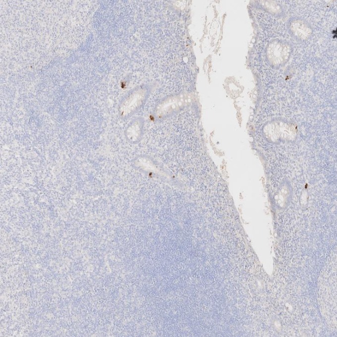 IHC staining of human appendicitis using 60135-2-Ig IHC staining of human appendicitis using 60135-2-Ig
