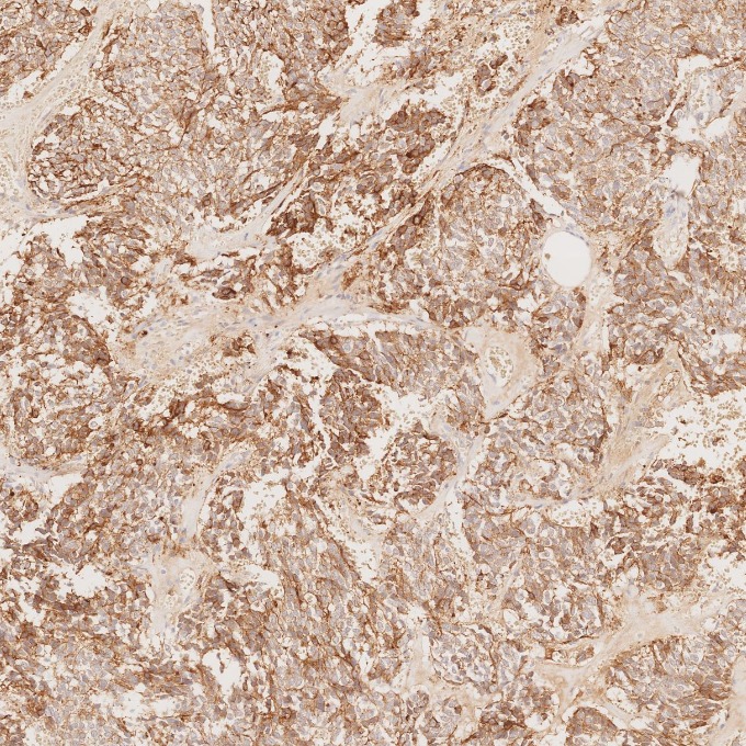 IHC staining of human pituitary adenoma using 60135-2-Ig IHC staining of human pituitary adenoma using 60135-2-Ig