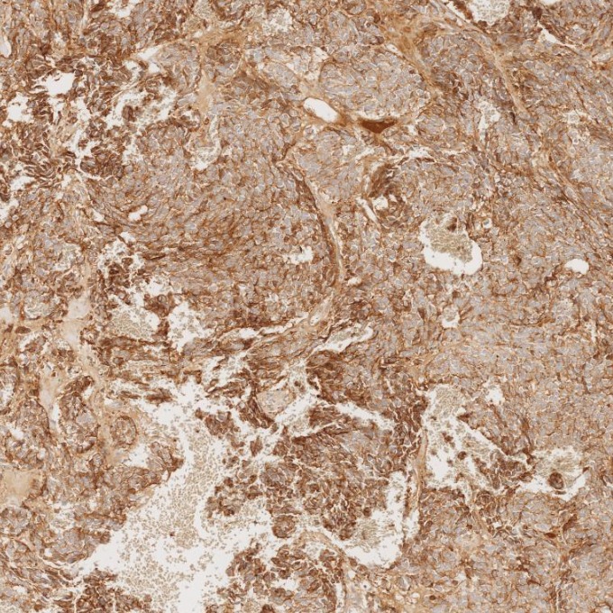 IHC staining of human pituitary adenoma using 60135-2-Ig IHC staining of human pituitary adenoma using 60135-2-Ig