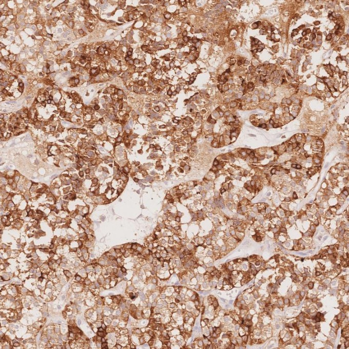IHC staining of human pituitary adenoma using 60135-2-Ig IHC staining of human pituitary adenoma using 60135-2-Ig