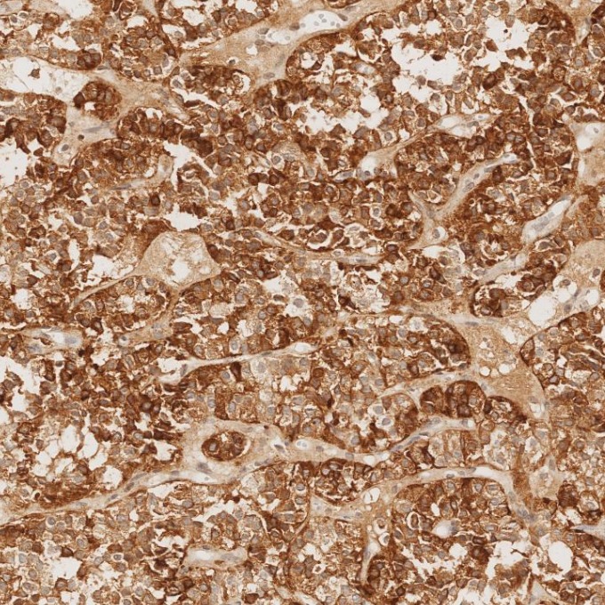 IHC staining of human pituitary adenoma using 60135-2-Ig IHC staining of human pituitary adenoma using 60135-2-Ig