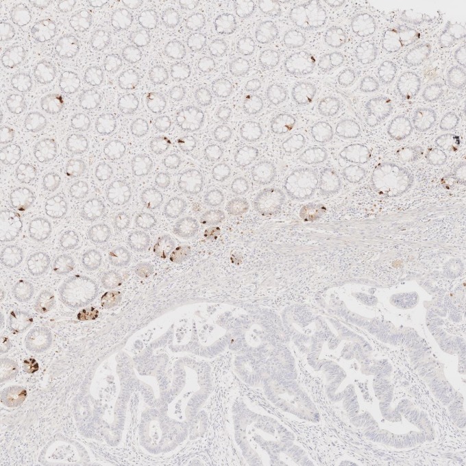 IHC staining of human colorectal cancer using 60135-2-Ig IHC staining of human colorectal cancer using 60135-2-Ig