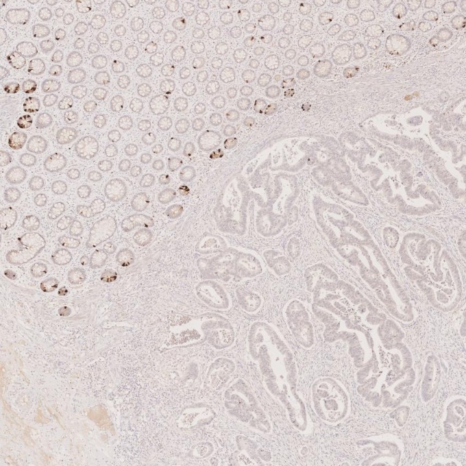 IHC staining of human colorectal cancer using 60135-2-Ig IHC staining of human colorectal cancer using 60135-2-Ig