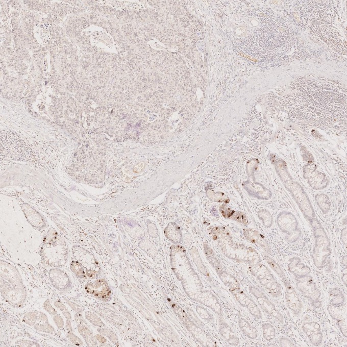 IHC staining of human stomach cancer using 60135-2-Ig IHC staining of human stomach cancer using 60135-2-Ig