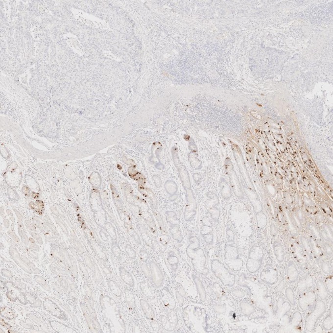 IHC staining of human stomach cancer using 60135-2-Ig IHC staining of human stomach cancer using 60135-2-Ig