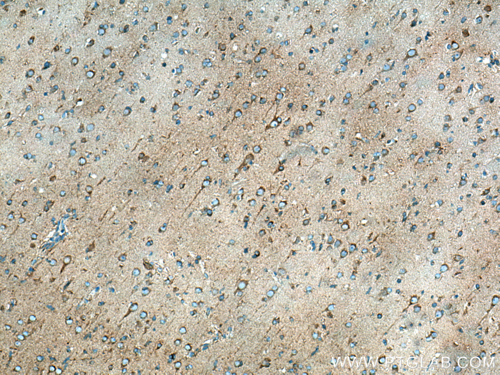 IHC staining of human gliomas using 10030-2-AP