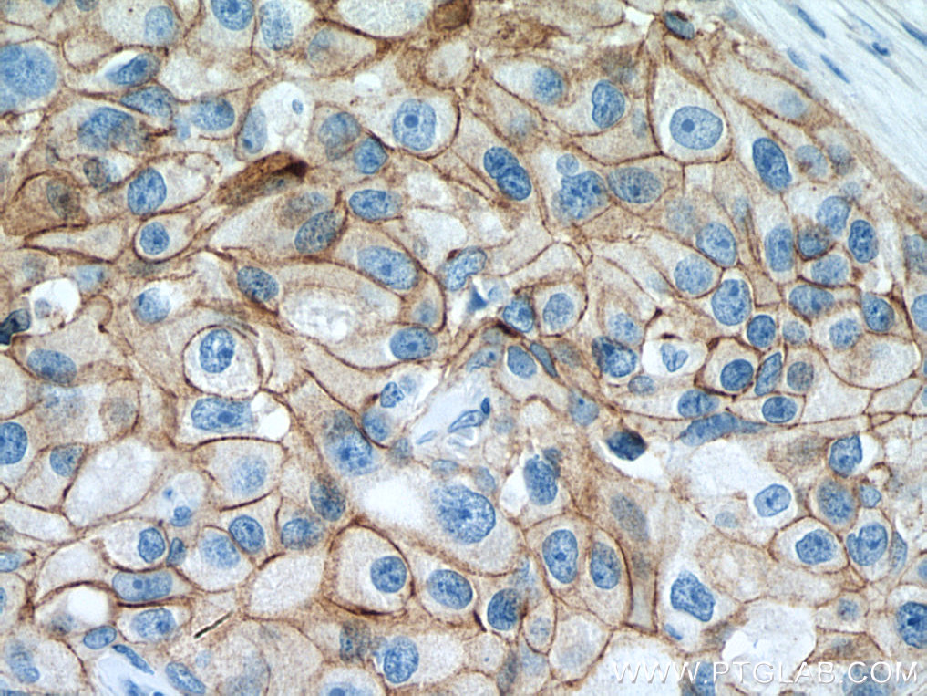IHC staining of human breast cancer using 27872-1-AP