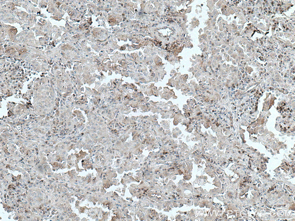 IHC staining of human lung cancer using 66989-1-Ig (same clone as 66989-1-PBS)