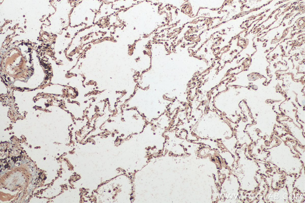 IHC staining of human lung cancer using 14523-1-AP (same clone as 14523-1-PBS)