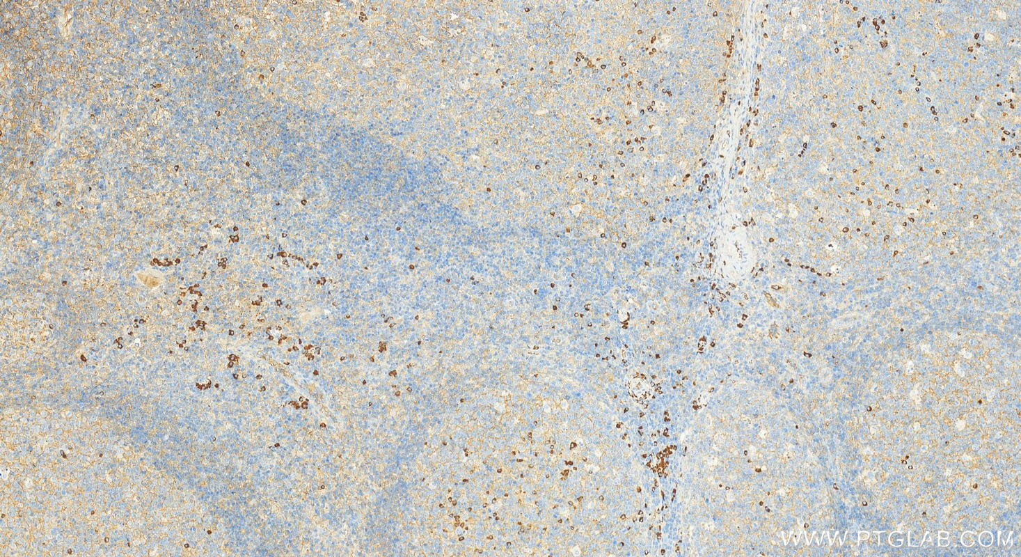 IHC staining of human tonsillitis using 31495-1-AP
