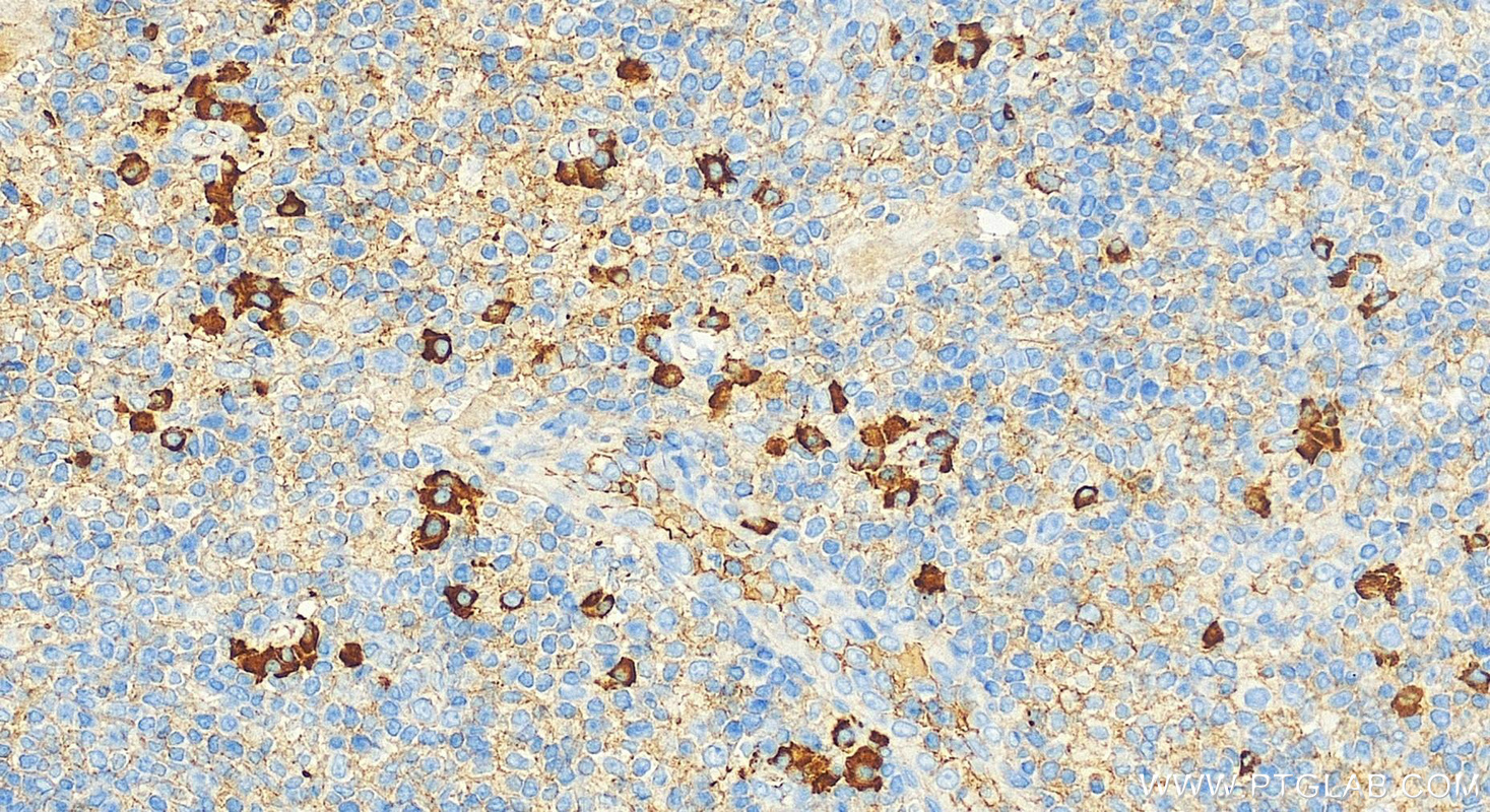 IHC staining of human tonsillitis using 31495-1-AP