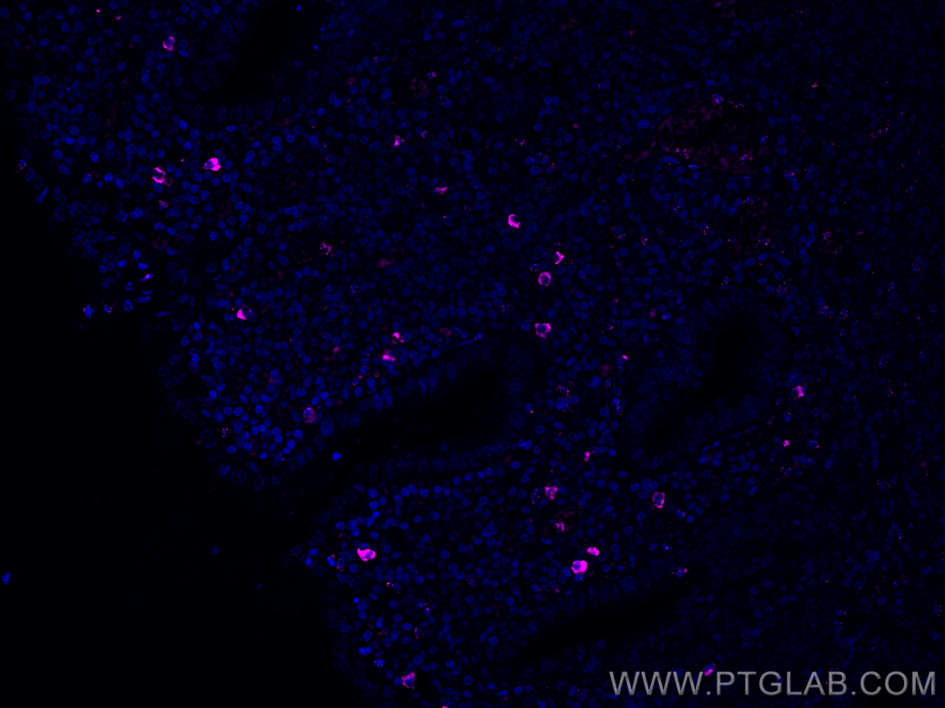 IF Staining of human appendicitis using CL647-66484