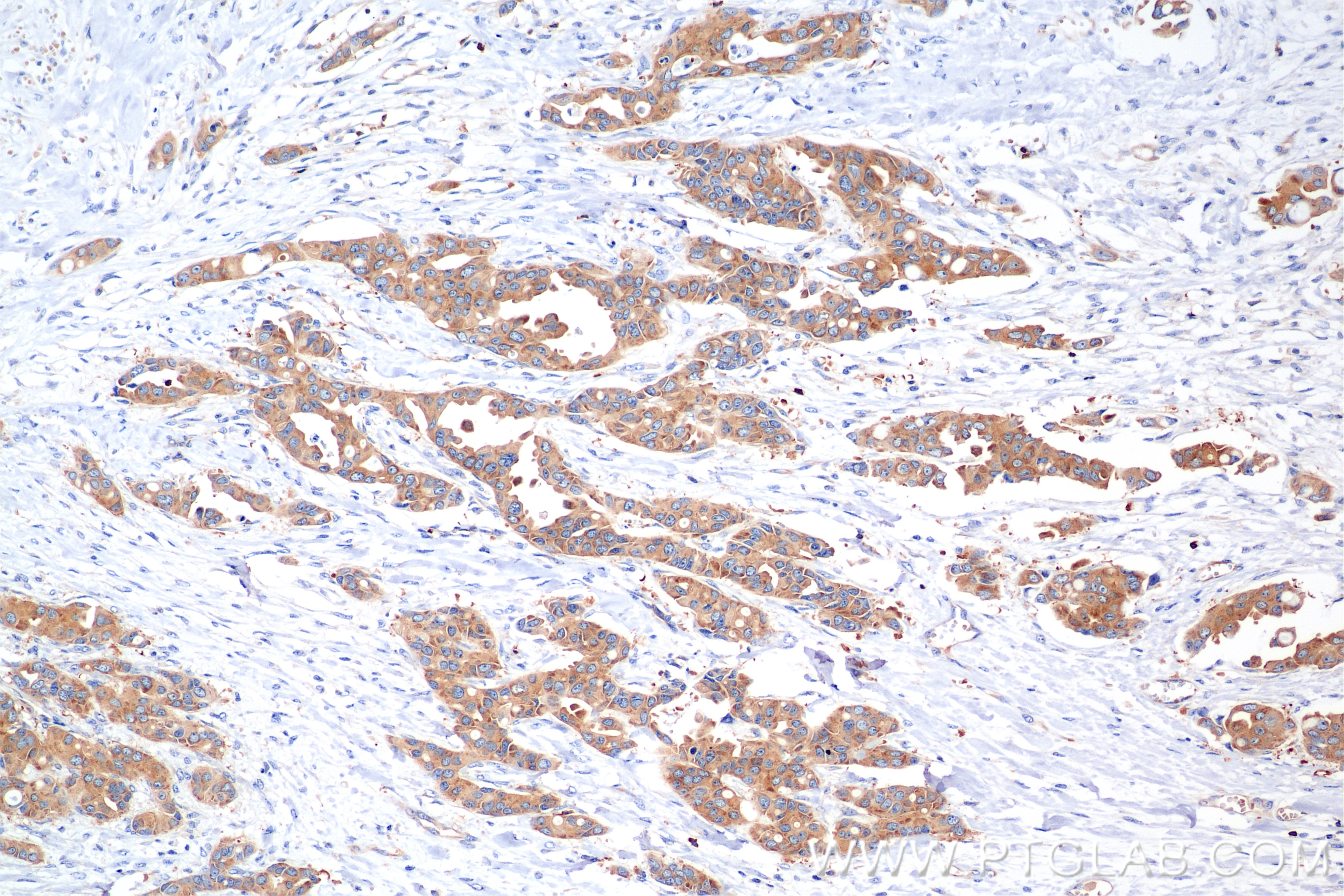 Immunohistochemical analysis of paraffin-embedded Human Breast Cancer(Her2+;ER-;PR-) slide using 85708-2-RR (mDia1 antibody) at dilution of 1:1000 (under 10x lens). Heat mediated antigen retrieval with Tris-EDTA buffer (pH 9.0). IHC staining of Human Breast Cancer(Her2+;ER-;PR-) using 85708-2-RR