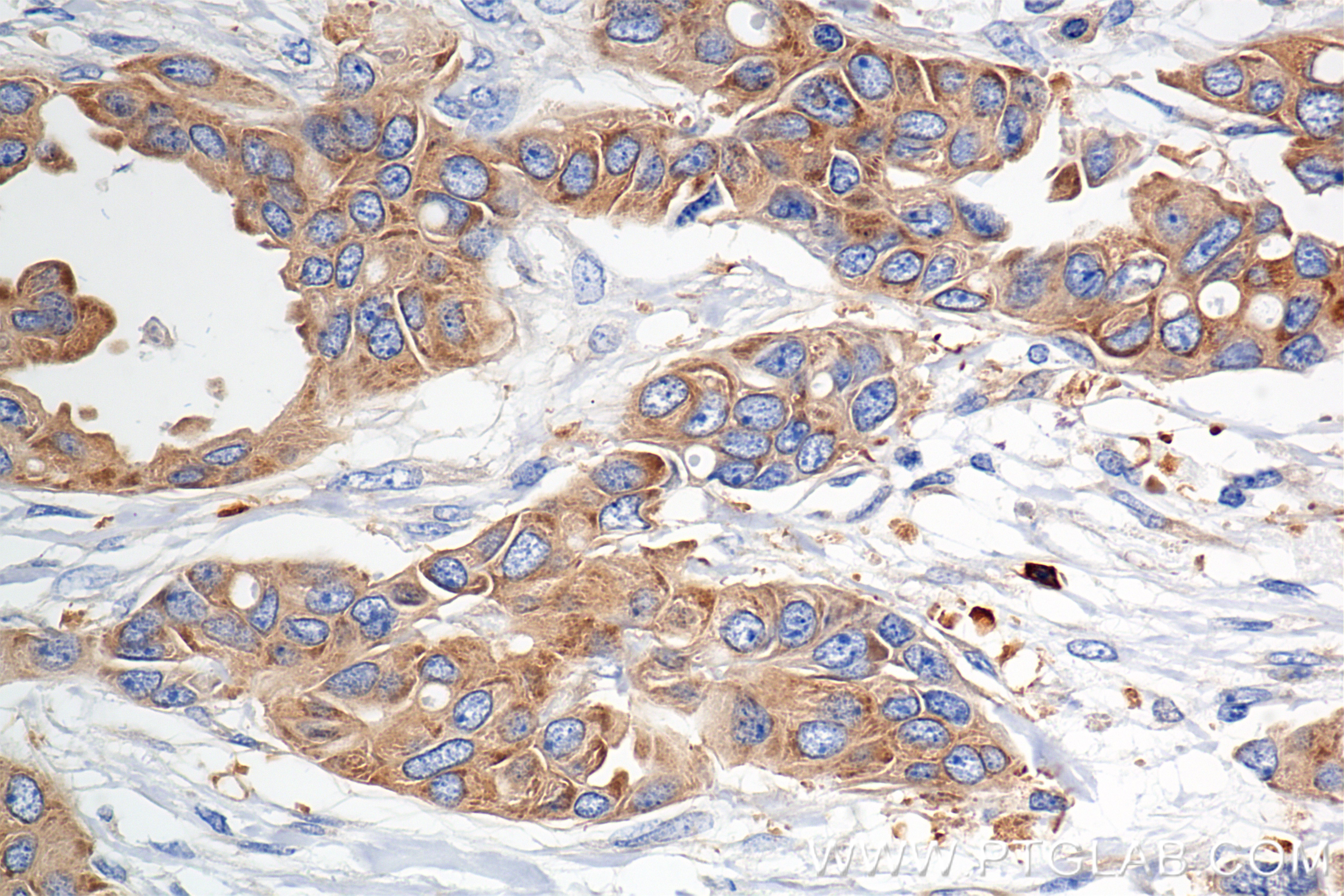 Immunohistochemical analysis of paraffin-embedded Human Breast Cancer(Her2+;ER-;PR-) slide using 85708-2-RR (mDia1 antibody) at dilution of 1:1000 (under 40x lens). Heat mediated antigen retrieval with Tris-EDTA buffer (pH 9.0). IHC staining of Human Breast Cancer(Her2+;ER-;PR-) using 85708-2-RR