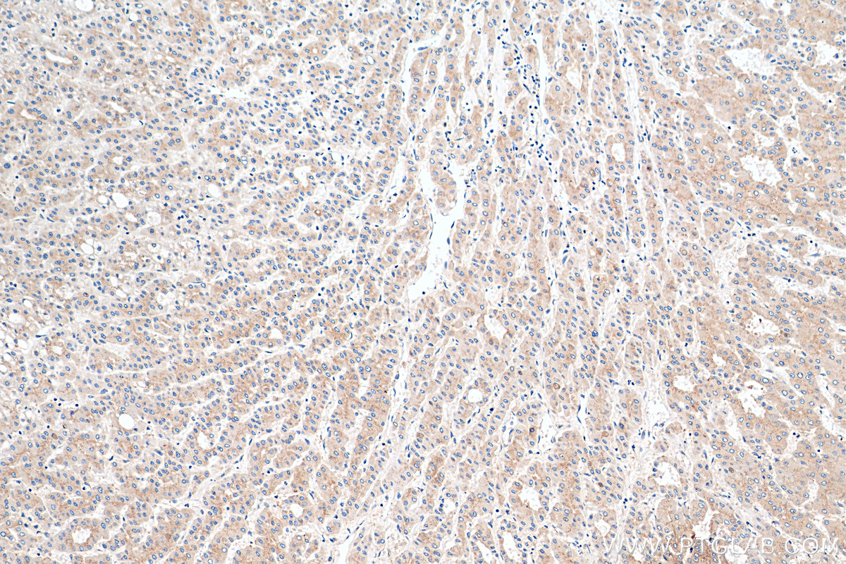 IHC staining of human liver cancer using 68100-1-Ig (same clone as 68100-1-PBS)