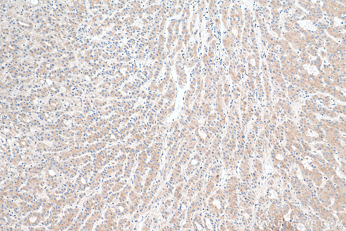 IHC staining of human liver cancer using 68100-1-Ig