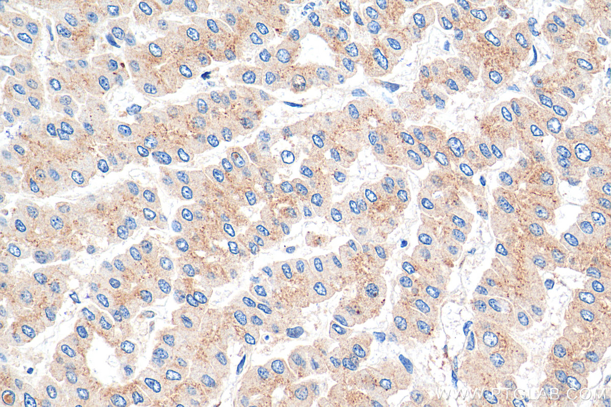 IHC staining of human liver cancer using 68100-1-Ig