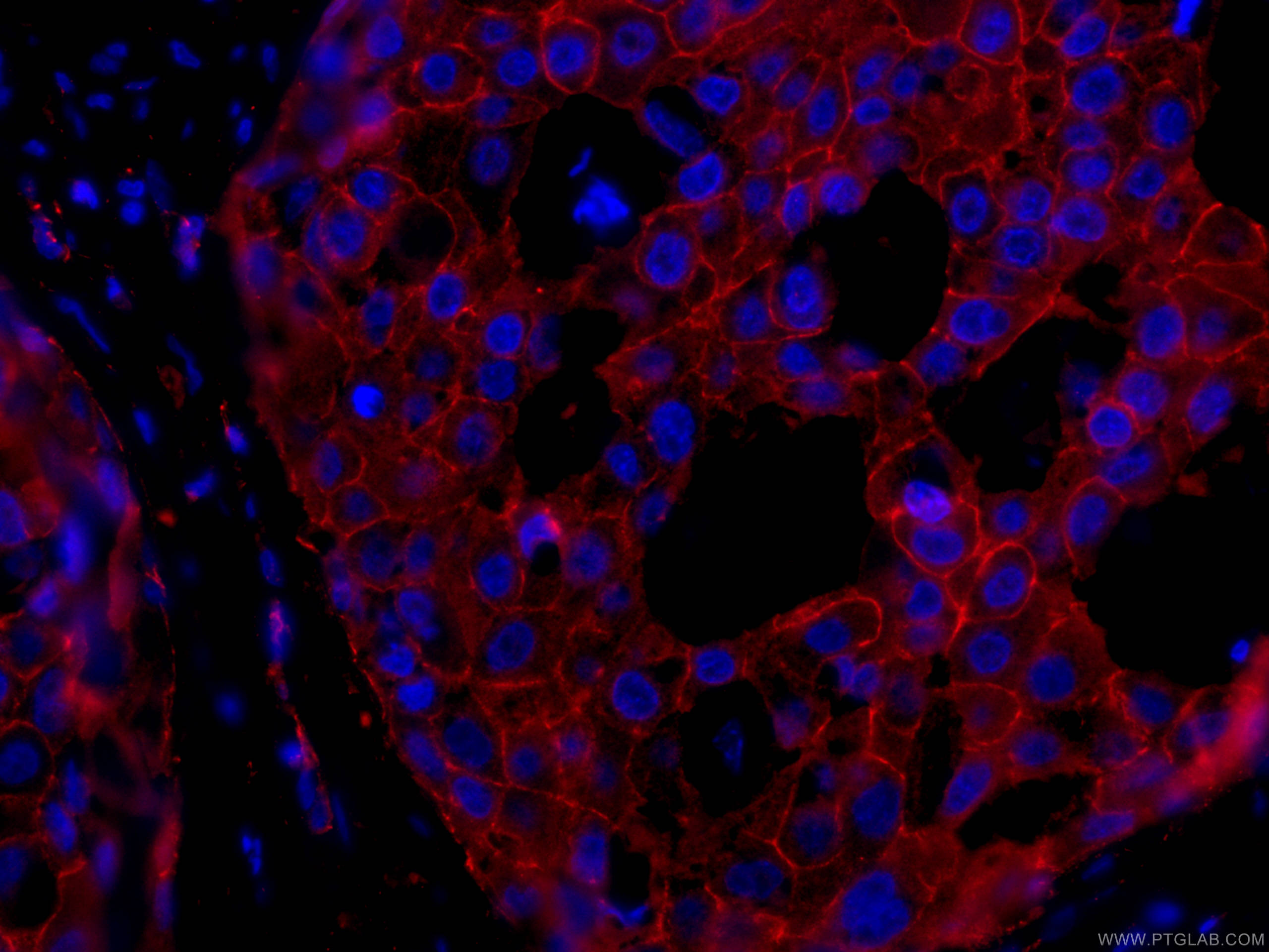 IF Staining of human breast cancer using CL594-66208