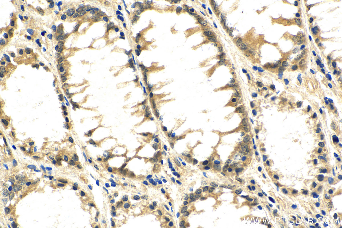 IHC staining of human colon cancer using 14064-1-AP