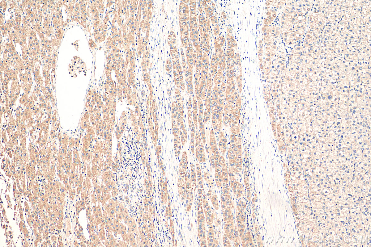 IHC staining of human liver cancer using 14064-1-AP