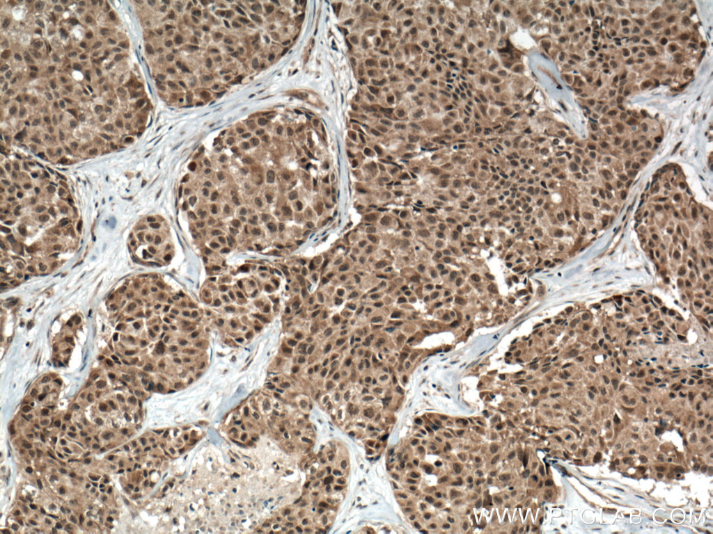 IHC staining of human lung cancer using 66234-1-Ig