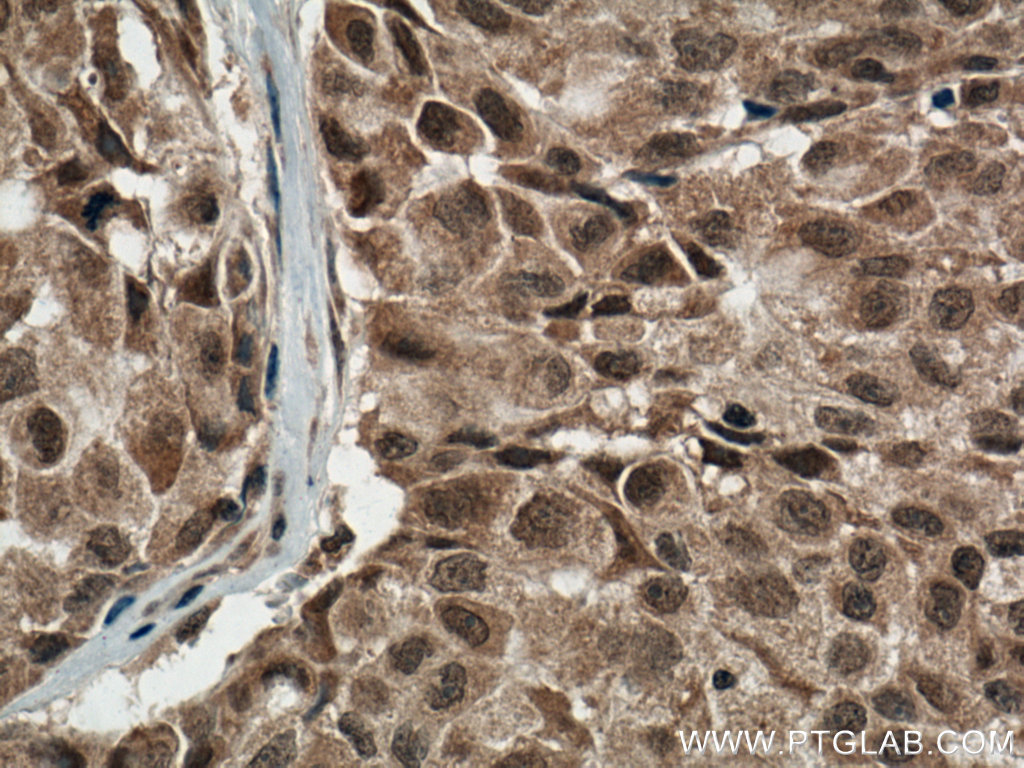 IHC staining of human lung cancer using 66234-1-Ig
